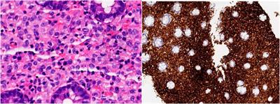 Intestinal Langerhans cell histiocytosis presenting with symptoms similar to inflammatory bowel disease: a case report